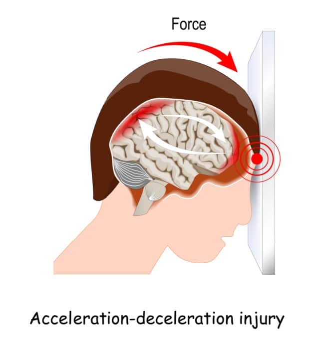 Traumatic Brain Injury Treatment Teens Buffalo NY acceleration and deceleration injury - Buffalo Occupational Therapy