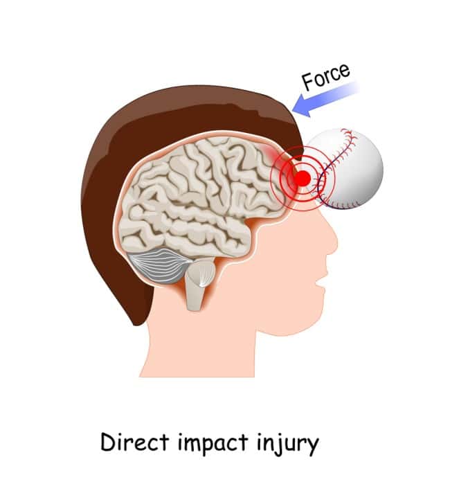 Traumatic Brain Injury Treatment Teens Buffalo NY direct force injury - Buffalo Occupational Therapy