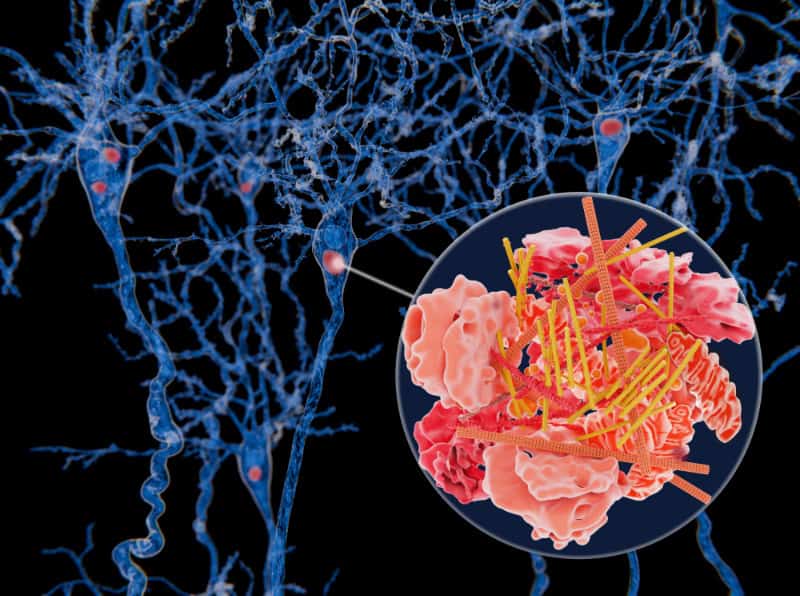 Lewy Body Dementia LBD Explain Lewy Body Proteins - Buffalo Occupational Therapy